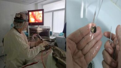 Photo of Doctors pulled out a 53-year-old coin stuck in a senior citizen’s nose