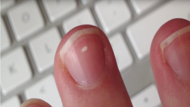 Photo of Are white markings dangerous on finger nails?